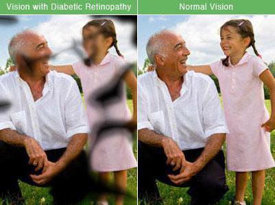 ретинопатия при сахарном диабете симптомы