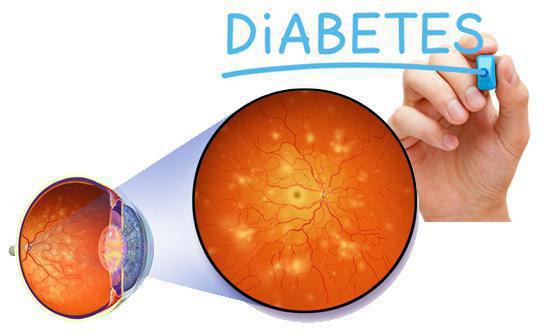 диабетическая ретинопатия симптомы