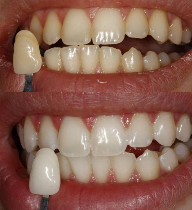 лазерная чистка зубов отзывы 