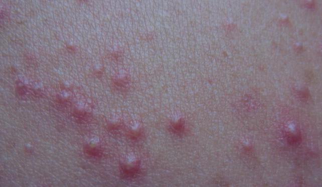 Может ли быть аллергия на хлорку симптомы thumbnail