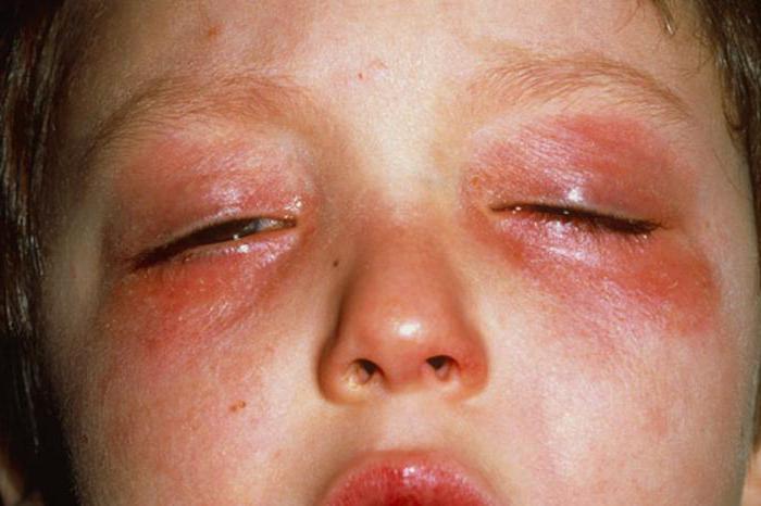 аллергия на хлорку в бассейне 