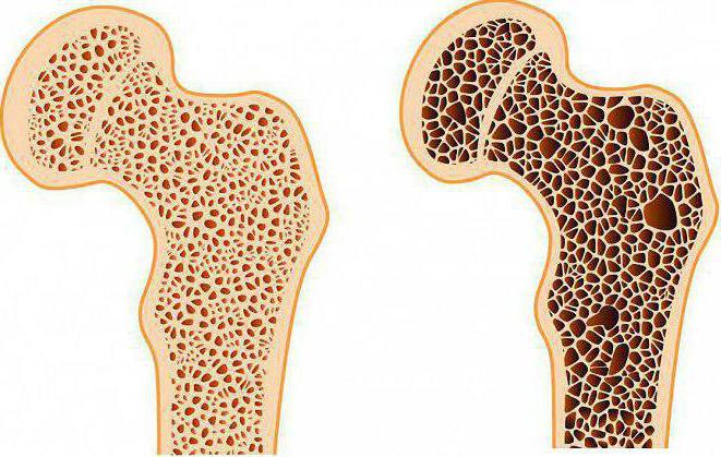 остеопороз тазобедренного сустава симптомы и лечение
