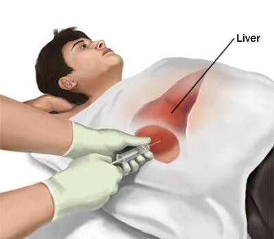 Как делается биопсия печени при гепатите thumbnail