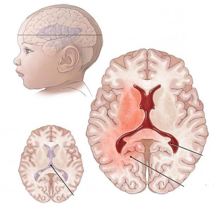 мозг новорожденного