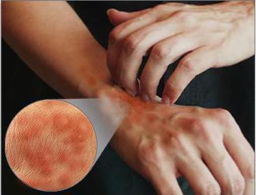 Аллергия или сыпь на руках и ногах thumbnail