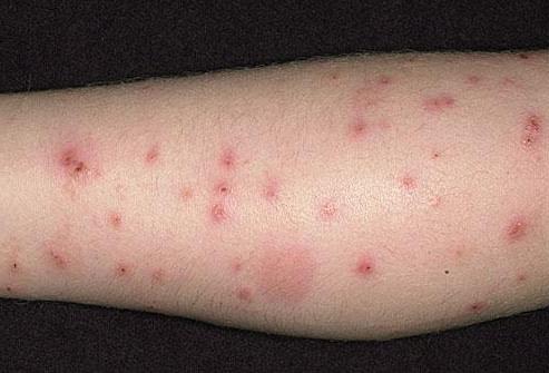 Аллергия в виде сыпи на ногах и руках thumbnail