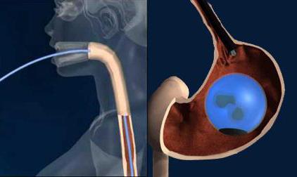 операция по уменьшению желудка отзывы