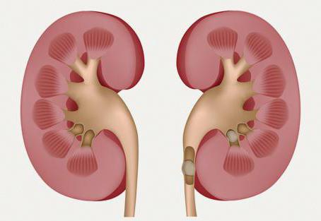 камни в мочеточнике симптомы у женщин лечение