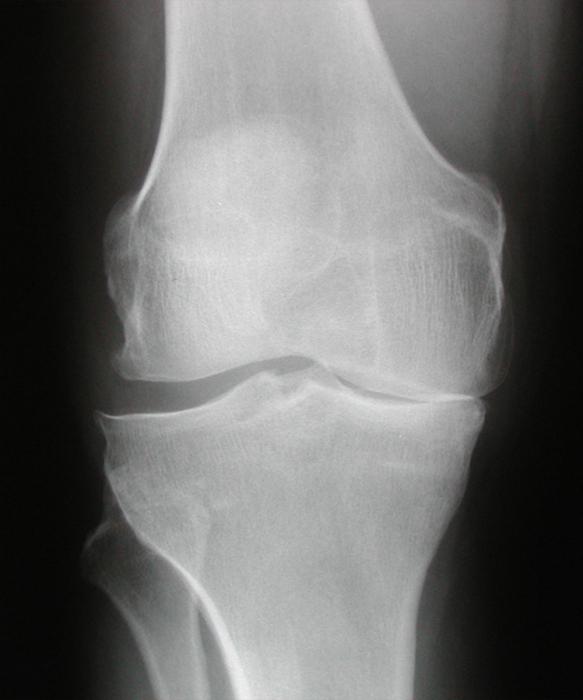 Фото артроза коленного сустава 2 степени