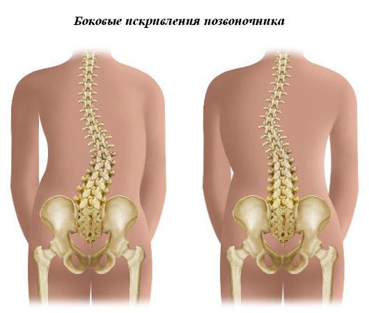 искривление позвоночника лечение