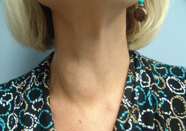Противопоказания при кисте щитовидки thumbnail