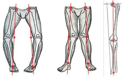 Гонартроз 2 3 степени коленного сустава лечение