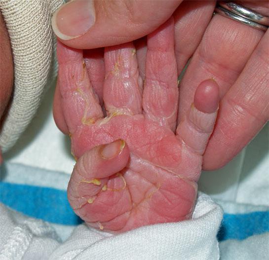 У ребенка шелушатся пальцы на руках: как найти причину
