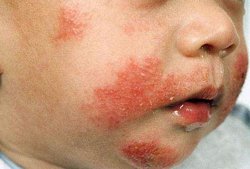 Аллергия на коже на порошок thumbnail