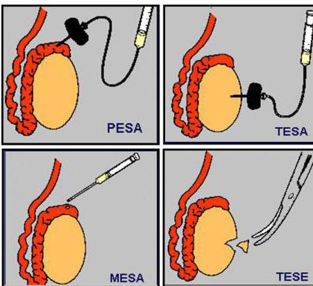 биопсия яичек у мужчин цена 