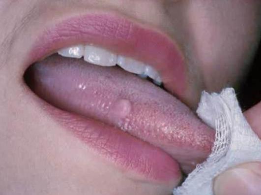 папиллома во рту лечение 
