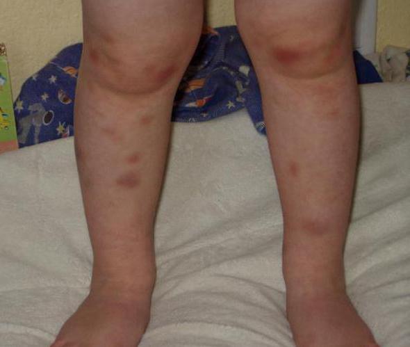 синяки на ногах у ребенка