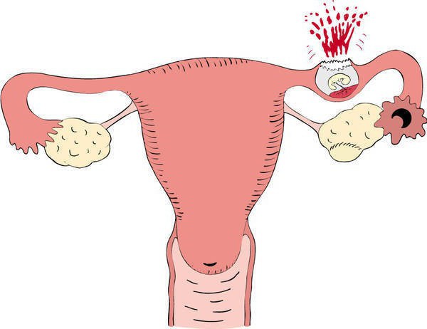Пульсирующая боль внизу живота слева у женщин при беременности thumbnail