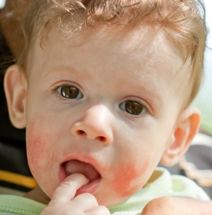  как выглядит аллергический дерматит у детей
