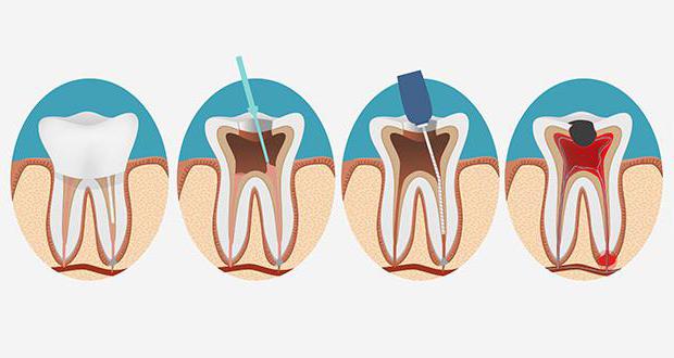депульпирование зуба