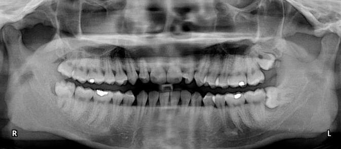 сколько каналов в зубе