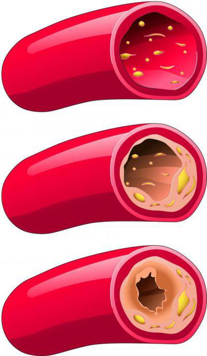 нестенозирующий атеросклероз внечерепных брахиоцефальных артерий