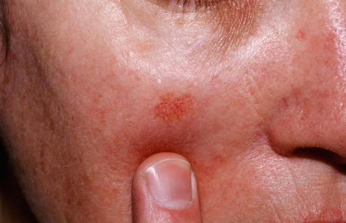 солнечный кератоз кожи симптомы лечение признаки
