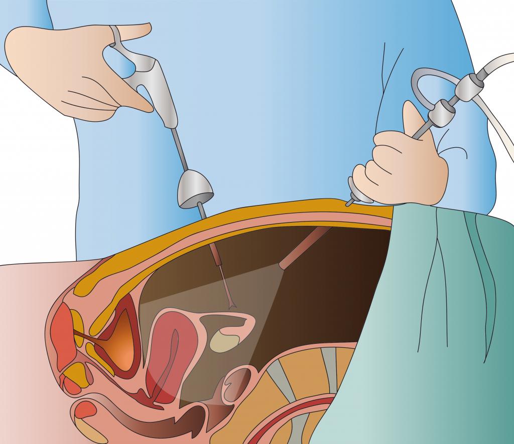 diagnostic laparoscopy