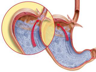 заброс желчи в желудок причины