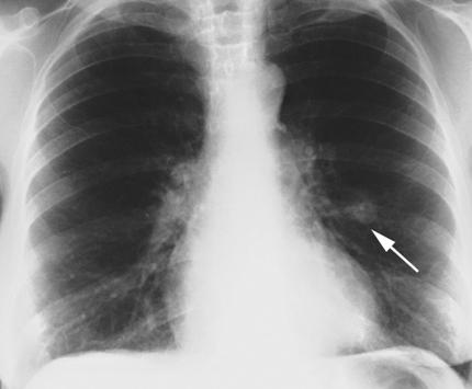 lung hamartoma