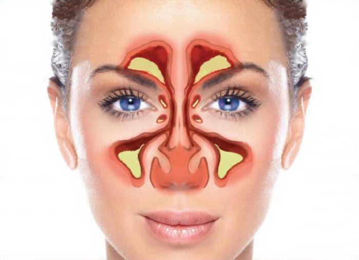 sphenoiditis what is it