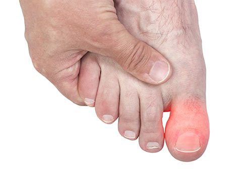 Можно ли при переломе пальца ноги обойтись без гипса thumbnail