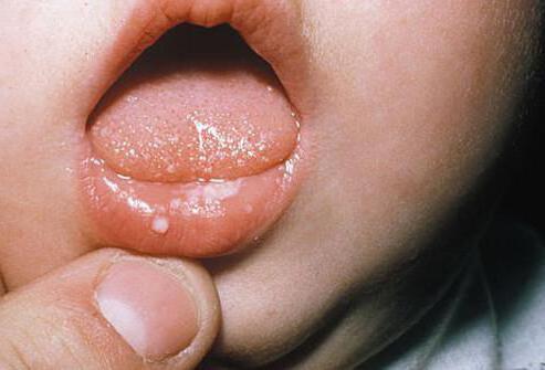 Мелкая сыпь на языке у ребенка 