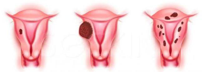 signs of uterine adenomyosis