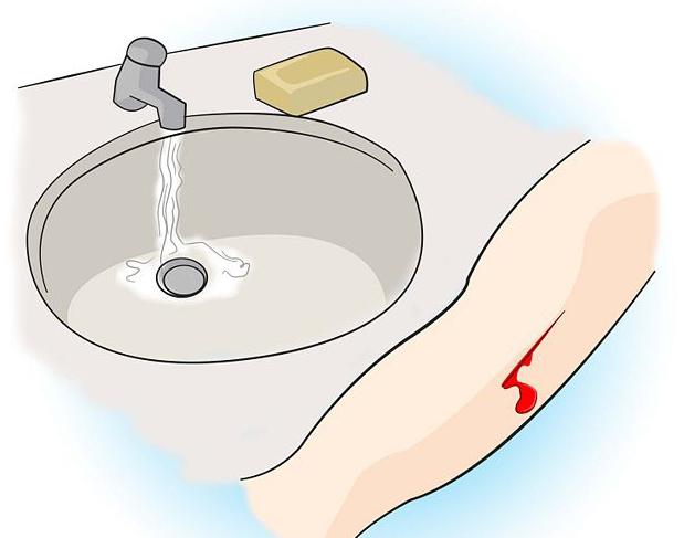 Как остановить кровь при порезе пальца: первая помощь и правила обработки раны при глубоком повреждении