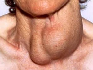 многоузловой зоб щитовидной железы