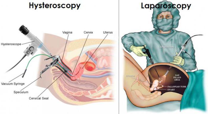 лапароскопия и гистероскопия 