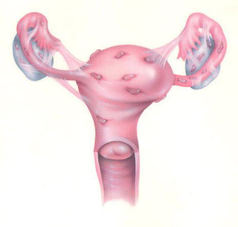 эндометриоидная киста правого яичника 