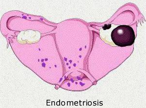 киста правого яичника эндометриоидная