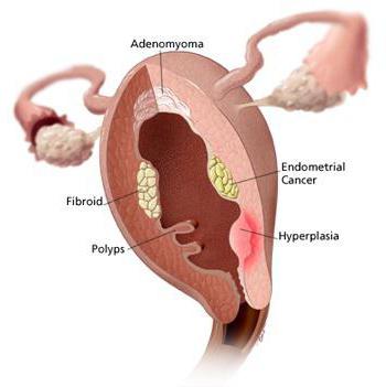 гиперплазия эндометрия после выскабливания