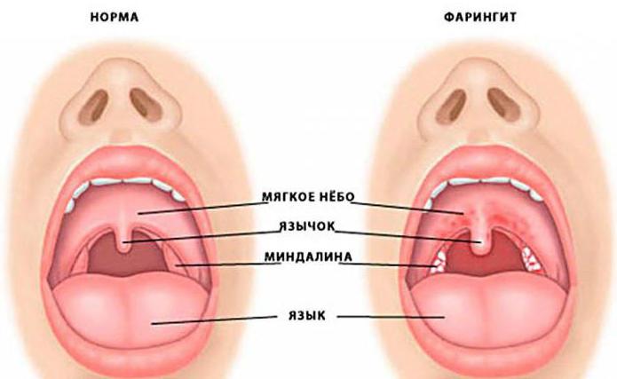 фарингит и ларингит отличия