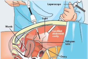 лапароскопия в гинекологии