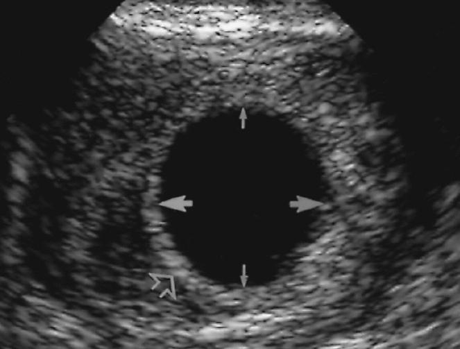 Почему не видно эмбрион. Анэмбриония – пустое плодное яйцо. Плодное яйцо 7 мм желточный мешок 6 мм. Анэмбриония – замершая беременность.