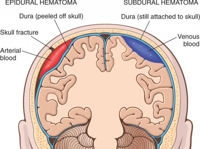 субдуральная гематома это