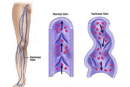 крем от варикоза varicose veins способ применения