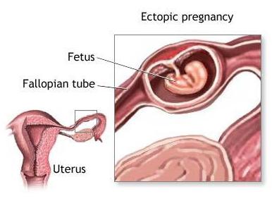 Режущая боль внизу живота у женщин при беременности thumbnail