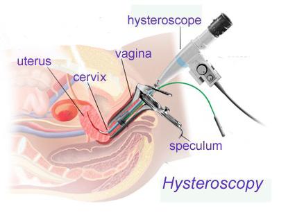 гистерорезектоскопия выделения