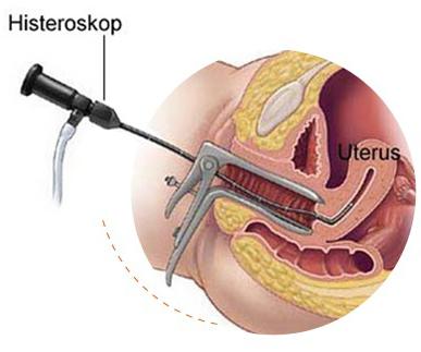 hysteroresectoscopy Price