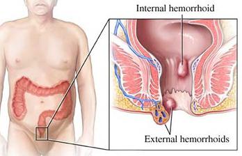 геморроидальный узел укдаление