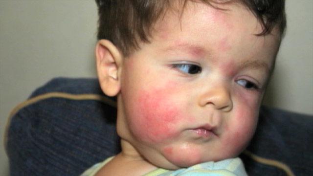 Температура на фоне аллергии у ребенка